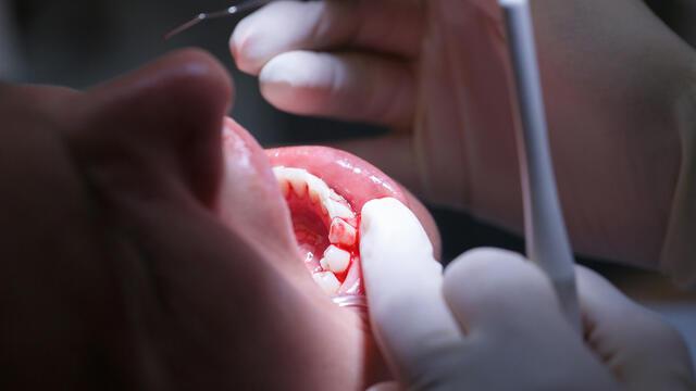 Diş eti kanaması neden olur? Sağlık Haberleri