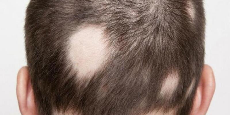 Saçkıran (Alopesi Areata) Nedir? Saçkıranın Belirtileri Nelerdir, Tedavisi Nasıl Yapılır?