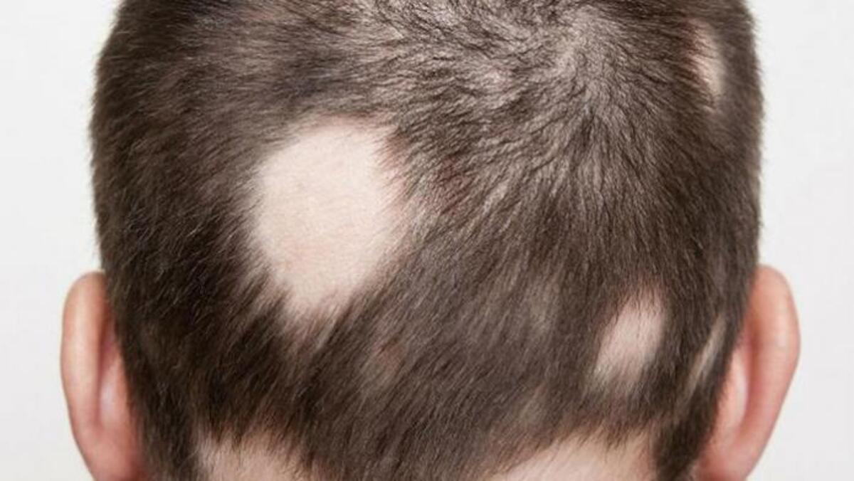 Выпадают волосы у ребенка 7 лет. Дерматомикоз (стригущий лишай). Гнёздная (очаговая алопеция).