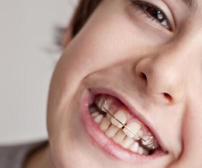 Diş teli ne işe yarar?