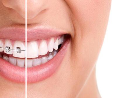 Kısa sürede diş teli tedavisi: Fastbraces