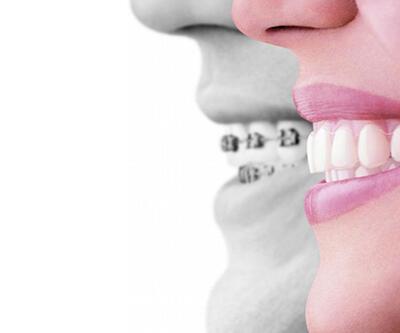 Diş çapraşıklığı kısa sürede düzelir mi?