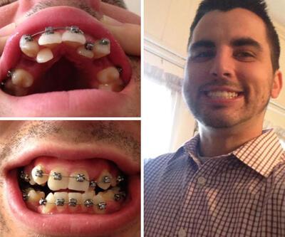 Ortodontik tedavinin fazlasıyla yaradığı insanlar