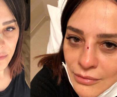 Şarkıcı Reyhan Karaca'nın burnu kırıldı