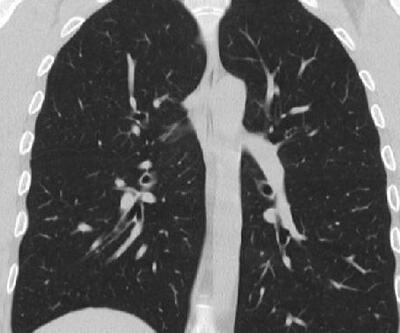 Uzmanlar açıkladı: Akciğer kanserini yüzde 70 oranında erken yakalıyor!