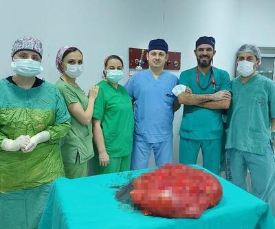 'Gaz' şikayetiyle gittiği hastanede karnından 21 kilo tümör çıkarıldı