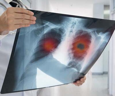Covid-19 için çekilen tomografiler akciğer kanserlerini erken evrede yakaladı