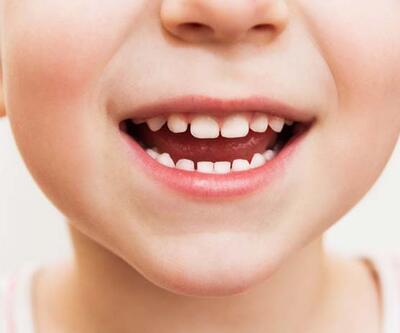 Çocukları diş çürüklerinden korumak için öneriler