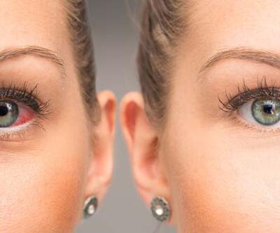 Körlükle sonuçlanabilen ‘göz tansiyonu’ tedavi edilebiliyor