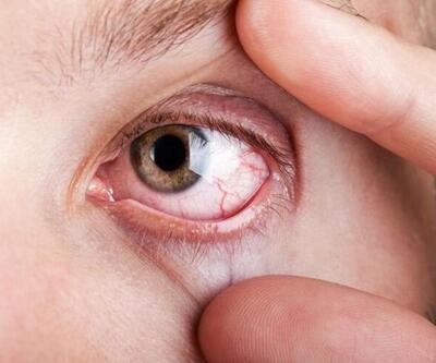 Göz tansiyonu körlüğe neden olabilir