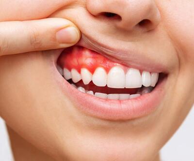 Yanlış yapılan diş ve diş eti işlemleri sağlığımızı da etkiliyor!
