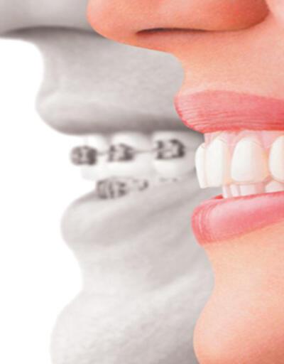 Telsiz ortodontik tedavi