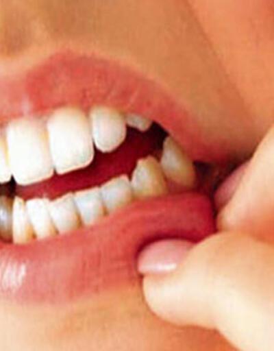Diş eti çekilmesi nedir? Nasıl tedavi edilir? 