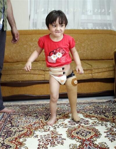 Minik Özge babasının kurduğu düzenekle yürüme öğrenmişti artık protez bacağı var
