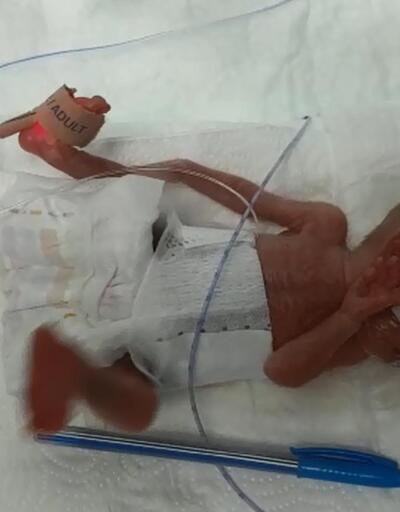 Türkiye’de bir ilk! 285 gram doğan Elçin bebek hayata tutundu