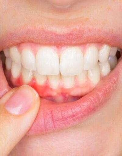 Diş eti hastalıkları kemik erimesine yol açabiliyor