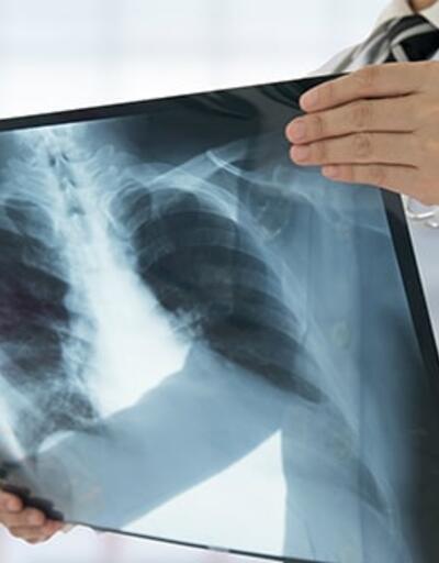 Akciğer Enfeksiyonu Nedir, Neden Olur? Akciğer Enfeksiyonu Tedavisi Nasıl Yapılır?