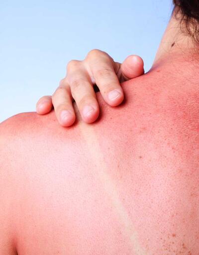 Güneş yanığı sandığınız rahatsızlık alerji çıkabilir