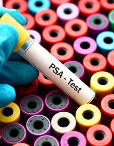 Geliştirilen idrar testiyle, prostat kanseri riski biyopsi olmadan tespit edilecek
