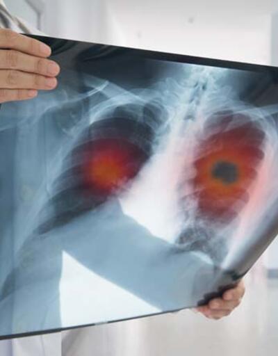 Akciğer kanseri erken teşhisle tedavi edilebilir