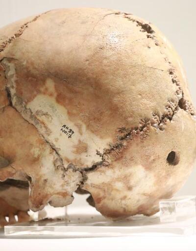 Dünyanın ilk beyin ameliyatı 10 bin 500 yıl önce Aksaray’da yapıldı