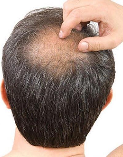 Erkeklerde saç dökülmesini durdurmak nasıl olur?
