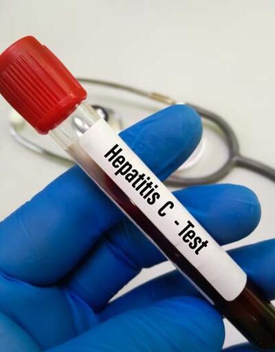 Uzman isimden 'hepatit' uyarısı: Çoğu kişi enfekte olduğunun farkında değil