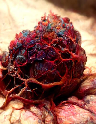 Karaciğer kanseri vücuda yayılması durumunda tedavi edilebilir mi?