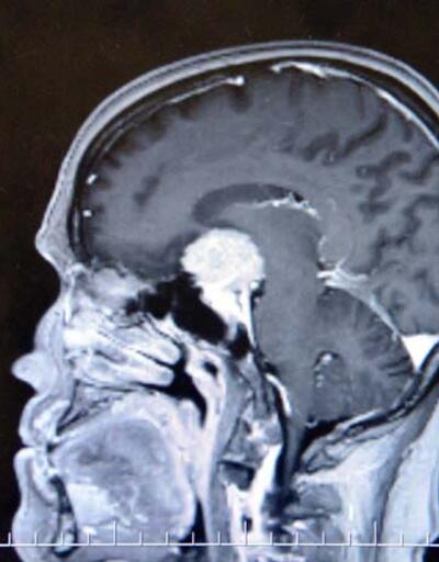 Beynindeki milyonda bir görülen tümör, ameliyatla alındı