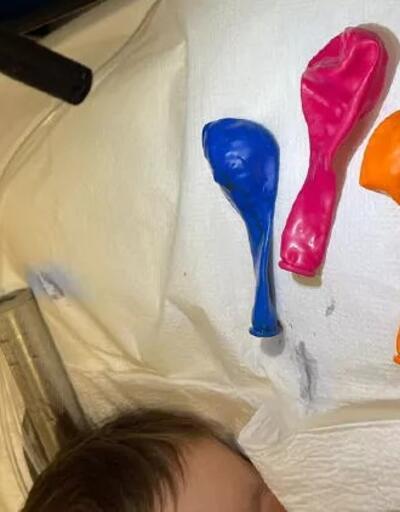 1 yaşındaki bebeğin midesinden 3 balon çıkarıldı