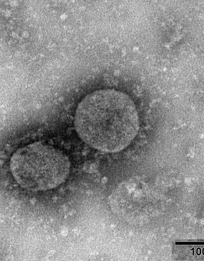 Koronavirüsün kanser hücrelerinin yayılımını hızlandırdığı ortaya çıktı