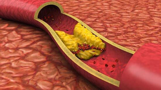 Sessiz tehlike kolesterole dikkat! Belirti vermiyor, kalp krizine zemin hazırlıyor 