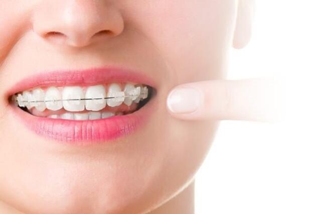 Diş teli olanlarda ağız bakımına dikkat Sağlık Haberleri
