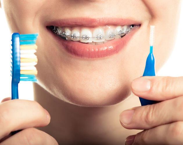 Diş teli olanlara ağız bakımı uyarısı Sağlık Haberleri