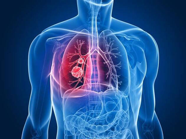 En çok görülen kanser türlerli arasında ilk 5'te! Akciğer kanserinin belirtileri neler, nasıl tedavi edilir?