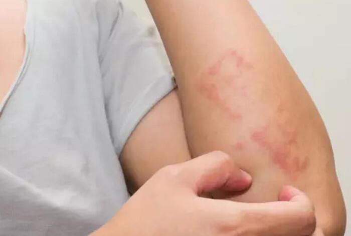 alerji nedir nasil gecer alerjiye ne iyi gelir evde bitkisel ve dogal yontemler saglik haberleri