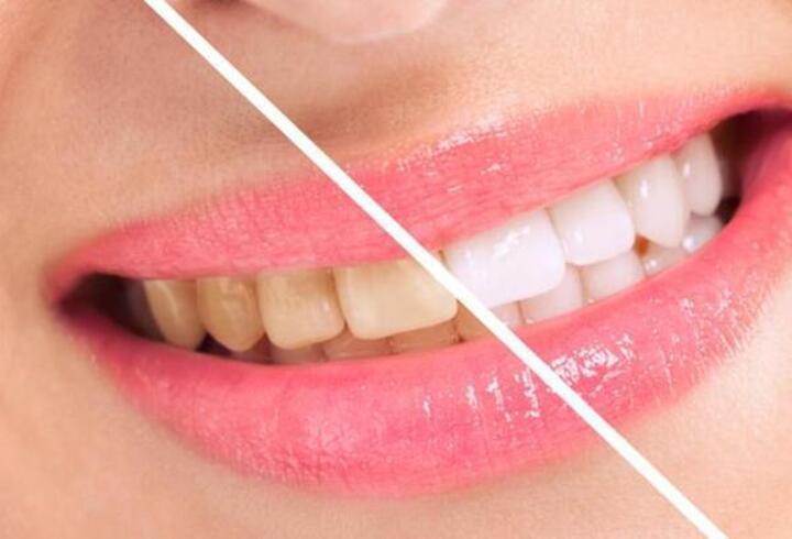 Sararmış dişleri beyaz dişler haline getirmenin 4 yolu