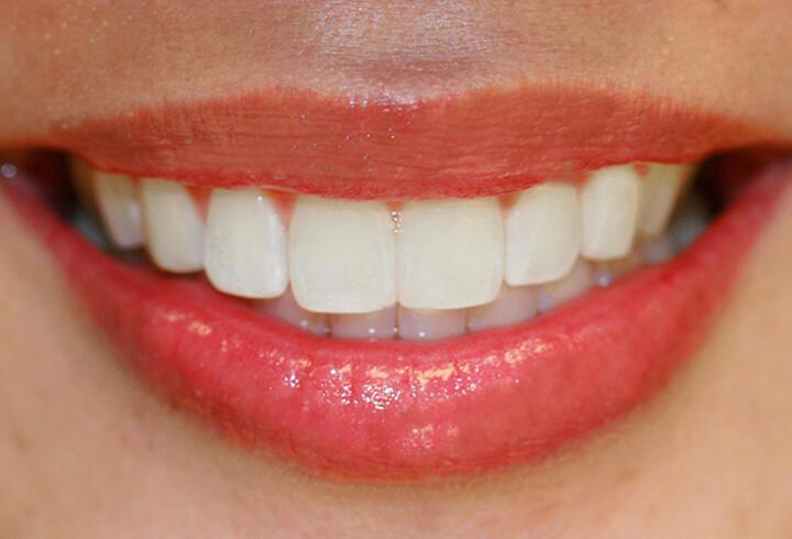 Sağlıklı dişlerin 5 püf noktası