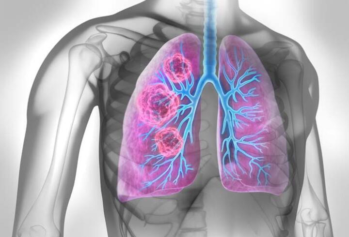 Akciğer kanserinin erken teşhis edilebilmesi için düzenli kontrol hayati önemde