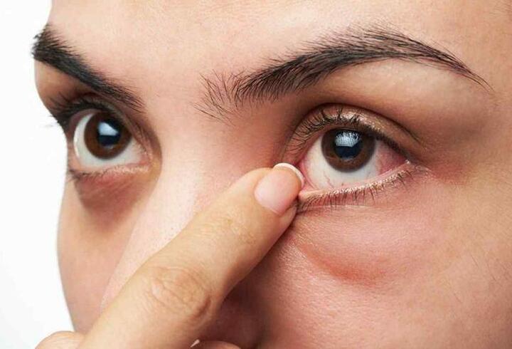 Göz enfeksiyonuna ne iyi gelir, neden olur? 