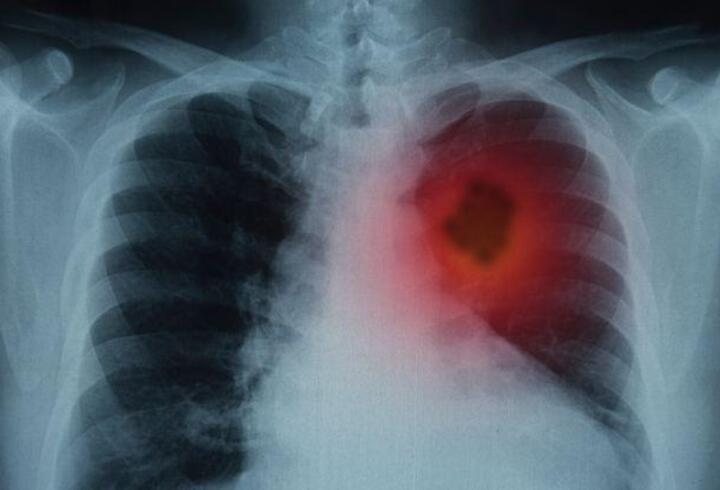 Aşı olanlarda 'Omicron' akciğere inmiyor