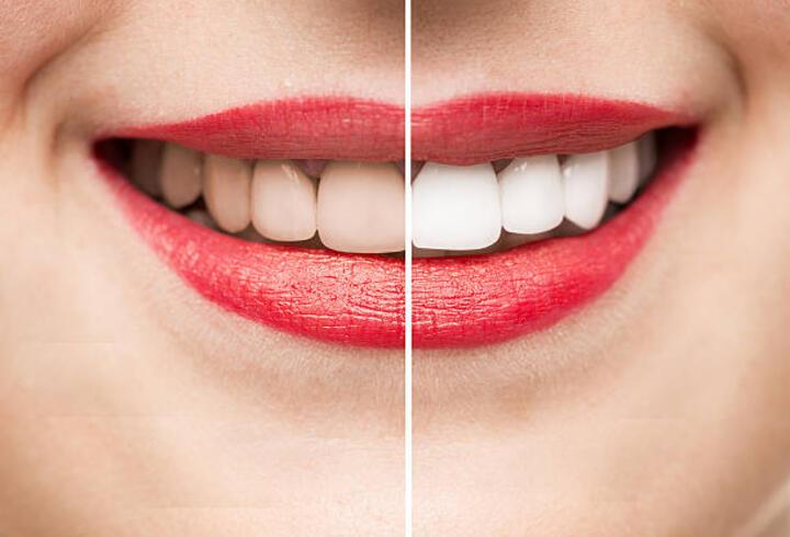 Bilinçsiz beyazlatma dişlerde hasar bırakabiliyor