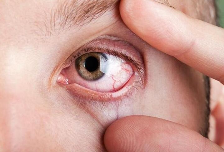 Göz tansiyonu körlüğe neden olabilir