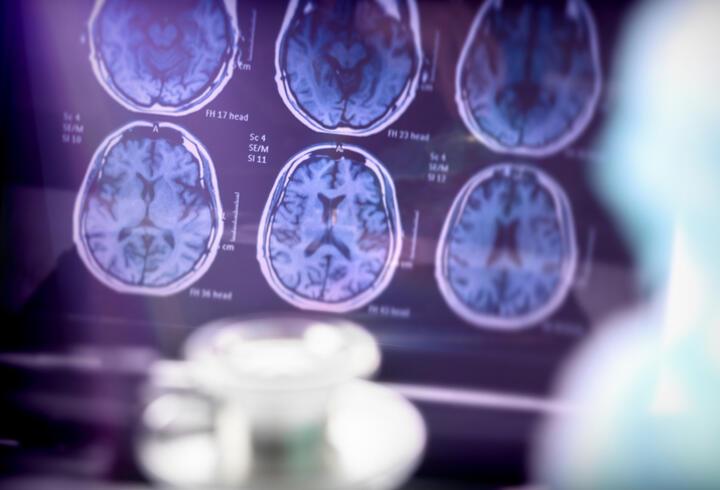 Alzheimer tedavisinde yeni umut: Hastalığın beyindeki tahribatını yavaşlatan ilk ilaç