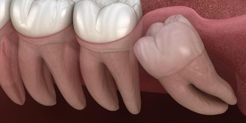 Yirmilik diş nedir, ne zaman çıkar? Sağlık Haberleri