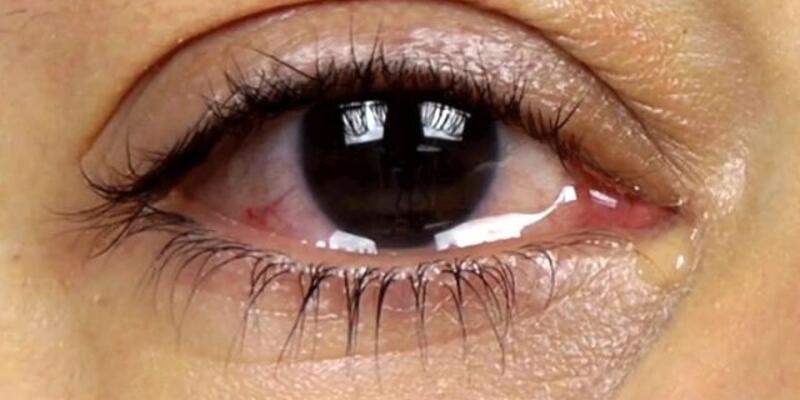 Göz Sulanması Nedir, Neden Olur? Göz Yaşarması Nasıl Geçer, Tedavisi