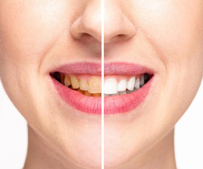 Dişlerin sararması önlenebilir mi? | Video