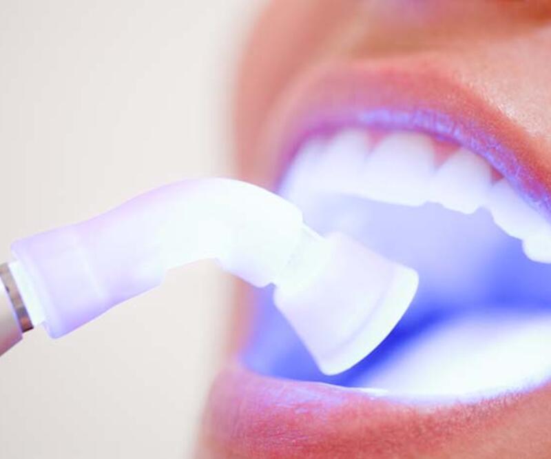 Bilinçsiz yapılırsa dişlerde hasar bırakıyor! İşte diş beyazlatma yöntemleri ve etkileri